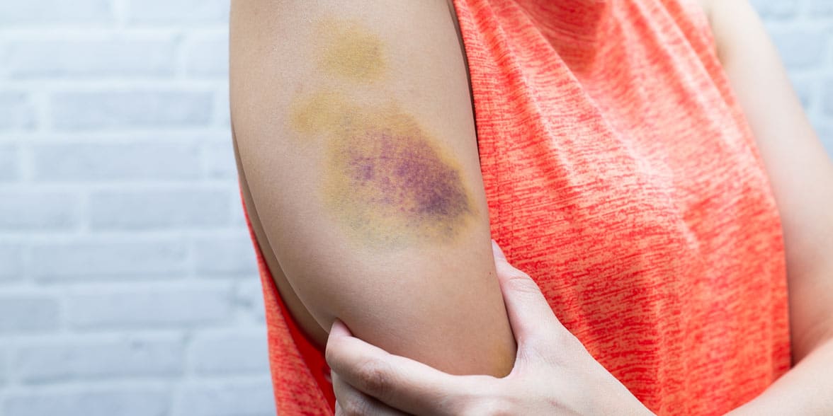 Photo of a bruised arm